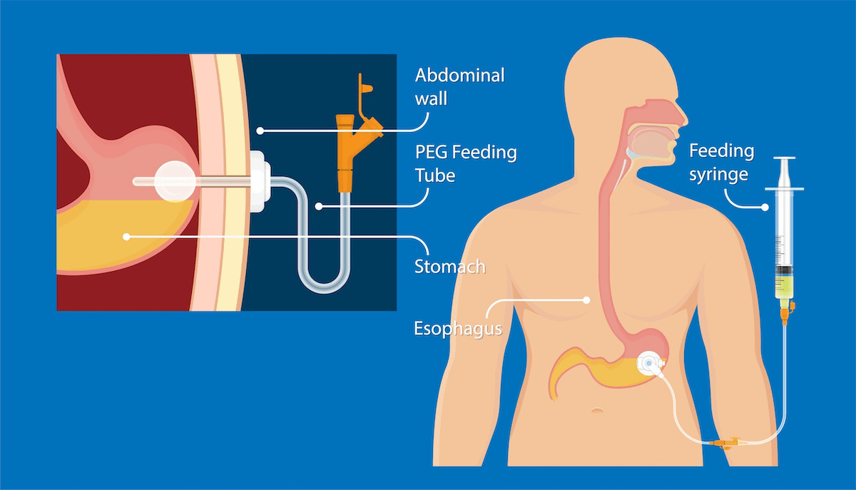 PEG feeding tube